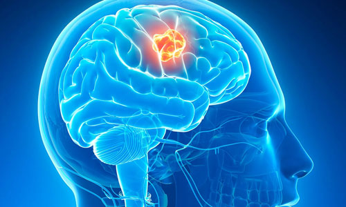 Brain Tumor (Benign & Malignant)