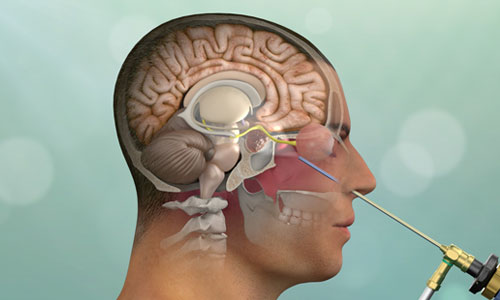 Pituitary Tumor Surgery