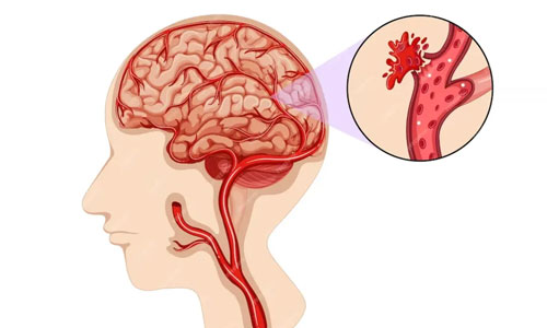 Brain Hemorrhage Treatment