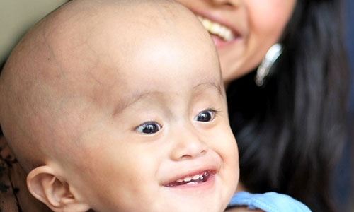 Hydrocephalus Treatment
